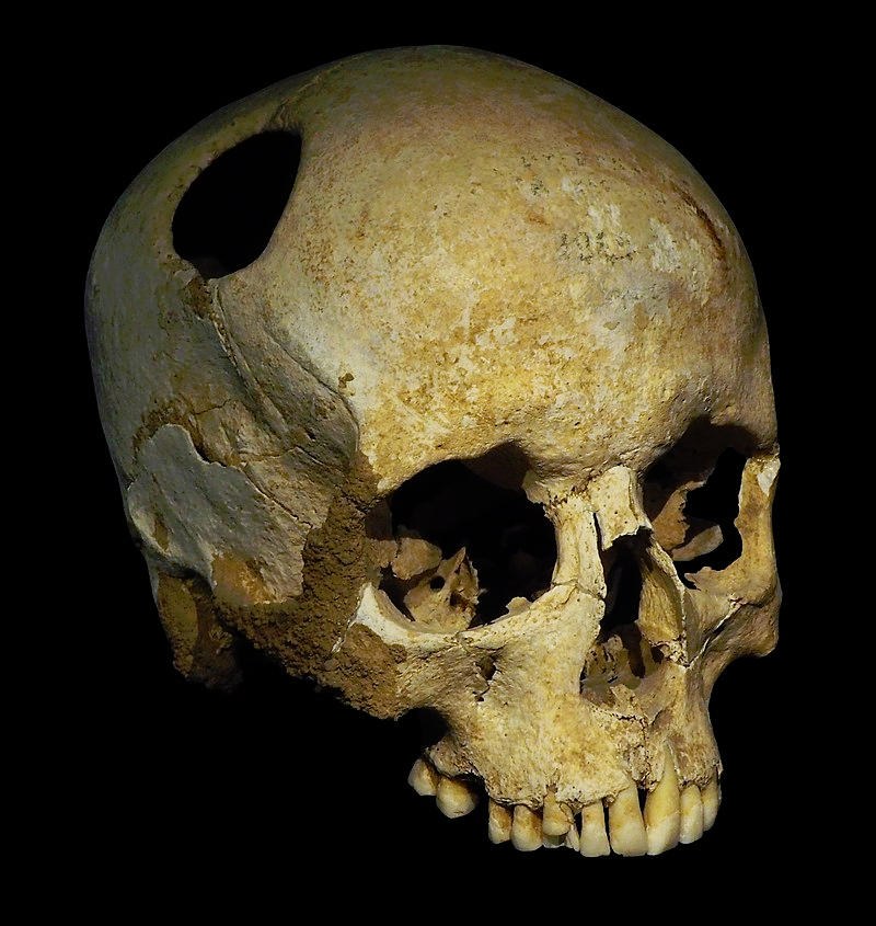 P4140363, Crâne de jeune fille trépanée au silex, Néolithique (3500 av. J.-C.) ; la patiente a survécu.