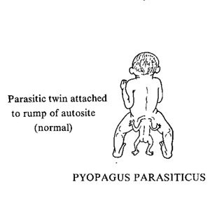 Gemellité parasitaire