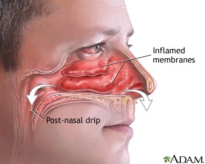 Inflammation des cornets nasaux