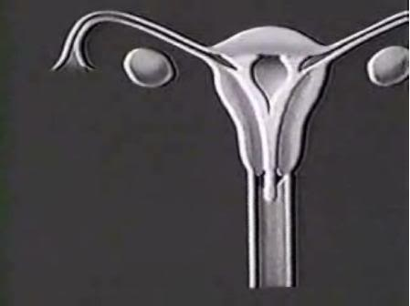 Utérus en coupe