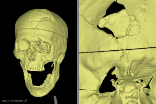 Reconstruction de l'incident de Phineas Gage Reconstruction de l'incident de Phineas Gage