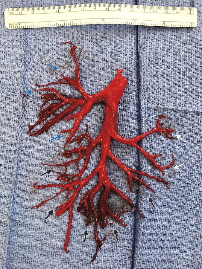 Un patient de 36 ans a toussé un caillot sanguin qui a moulé exactement la bronche droite de son poumon