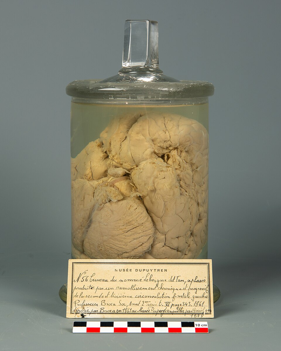 Cerveau de Louis Victor Leborgne dit Tan ou Tantan, atteint d'aphasie, datant de 1861. Préparation humide. Pièce étudiée et décrite par Pierre Paul Broca. Cerveau de Louis Victor Leborgne dit Tan ou Tantan, atteint d'aphasie, datant de 1861. Préparation humide. Pièce étudiée et décrite par Pierre Paul Broca.