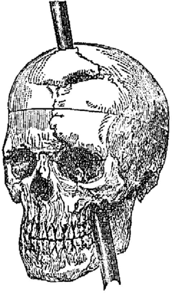 Vue de face et de profil du crâne, montrant la direction dans laquelle le fer a traversé sa cavité ; l'aspect actuel de la ligne de fracture, ainsi que le grand fragment antérieur de l'os frontal, qui s'était entièrement détaché, puis avait été remis en place et partiellement réuni. Vue de face et de profil du crâne, montrant la direction dans laquelle le fer a traversé sa cavité ; l'aspect actuel de la ligne de fracture, ainsi que le grand fragment antérieur de l'os frontal, qui s'était entièrement détaché, puis avait été remis en place et partiellement réuni.